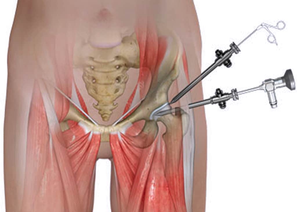 La chirurgie de la hanche Nice - Institut Arthrose et sport à Nice